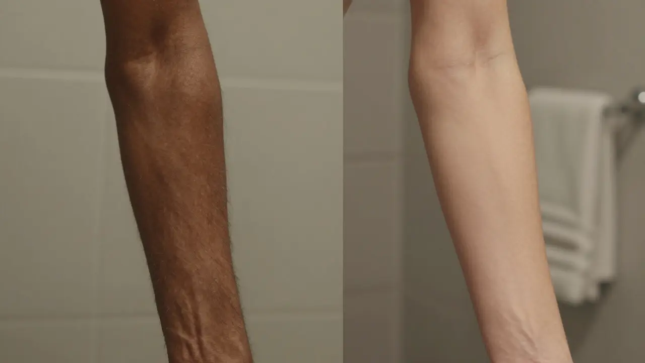 Before and after skin texture comparison on arms