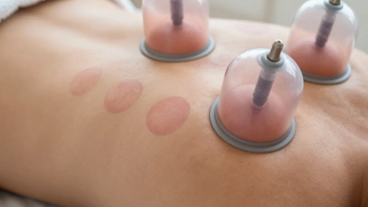 Close-up of faint red circular marks on skin after cupping, showing natural circulation response without bruising.
